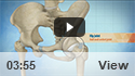 Ultrasound Guided Hip Injections
