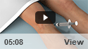 Viscosupplementation for Osteoarthritis